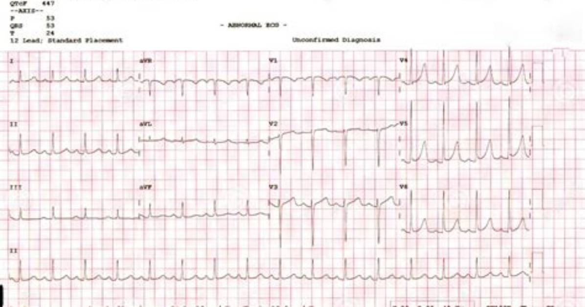 What Is Abnormal Ecg Test?