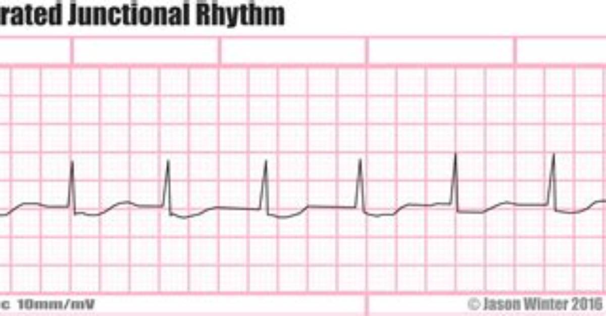 What Is Accelerated Junctional Rhythm?