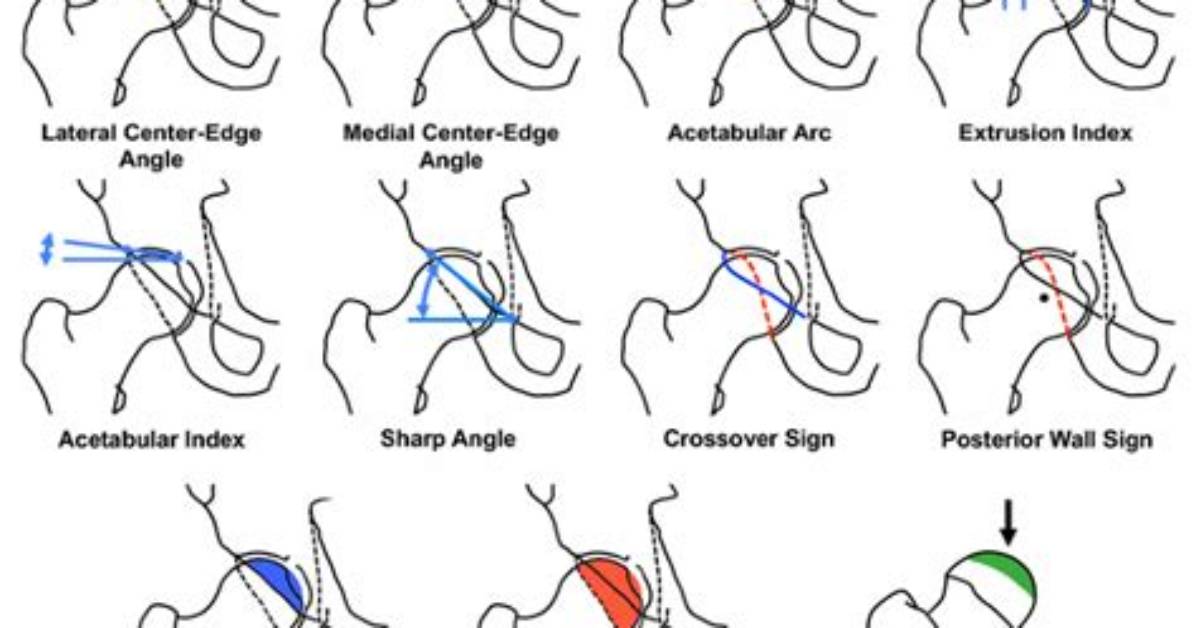 What Is Acetabular Overcoverage?