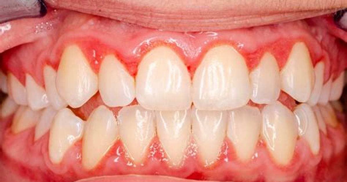 What Is Acute Gingivitis