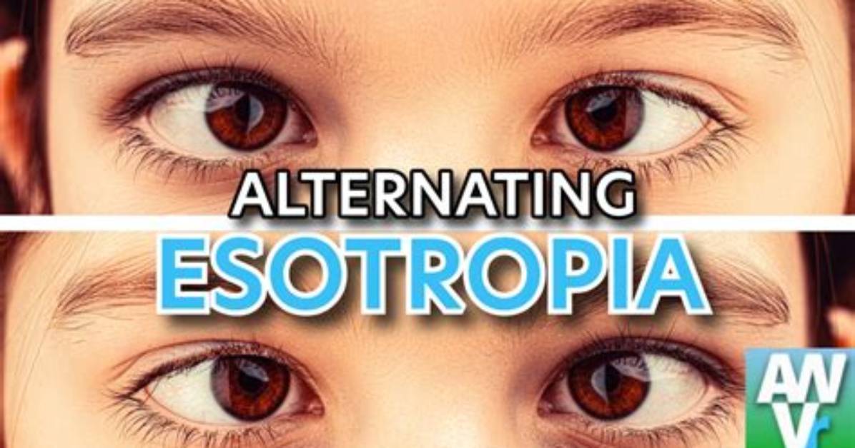 What Is Alternating Esotropia?