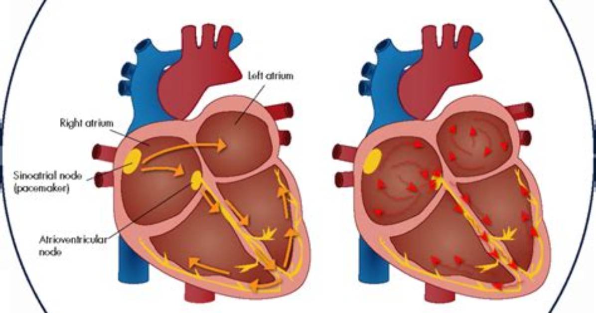What Is an Afib Attack