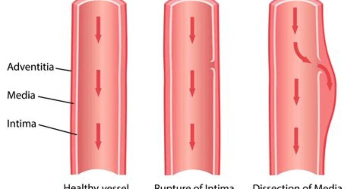 What Is an Dissecting Aneurysm