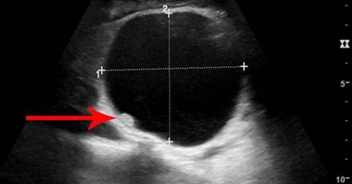 What Is an Echogenic Cyst?