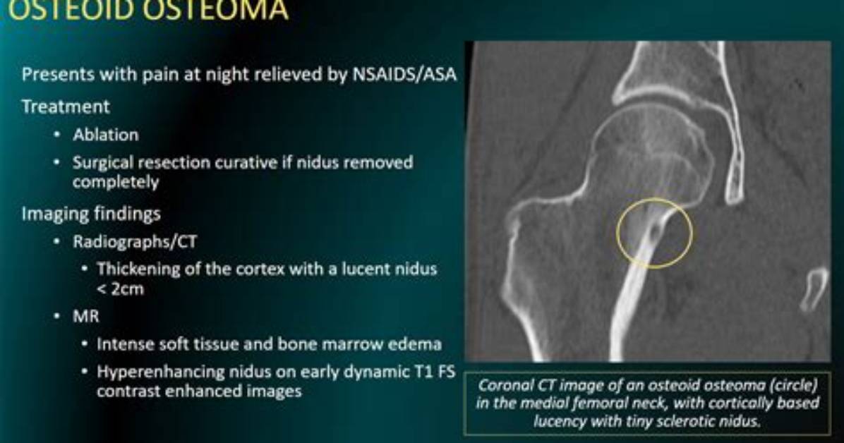What Is an Osteoid