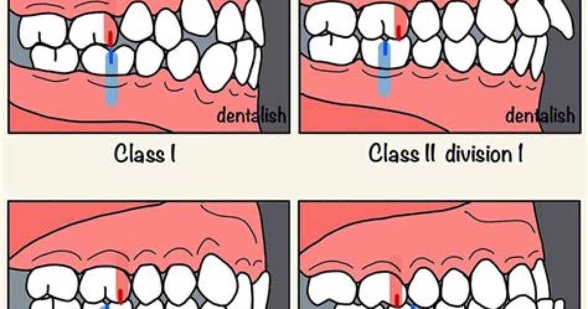 What Is Angle Classification