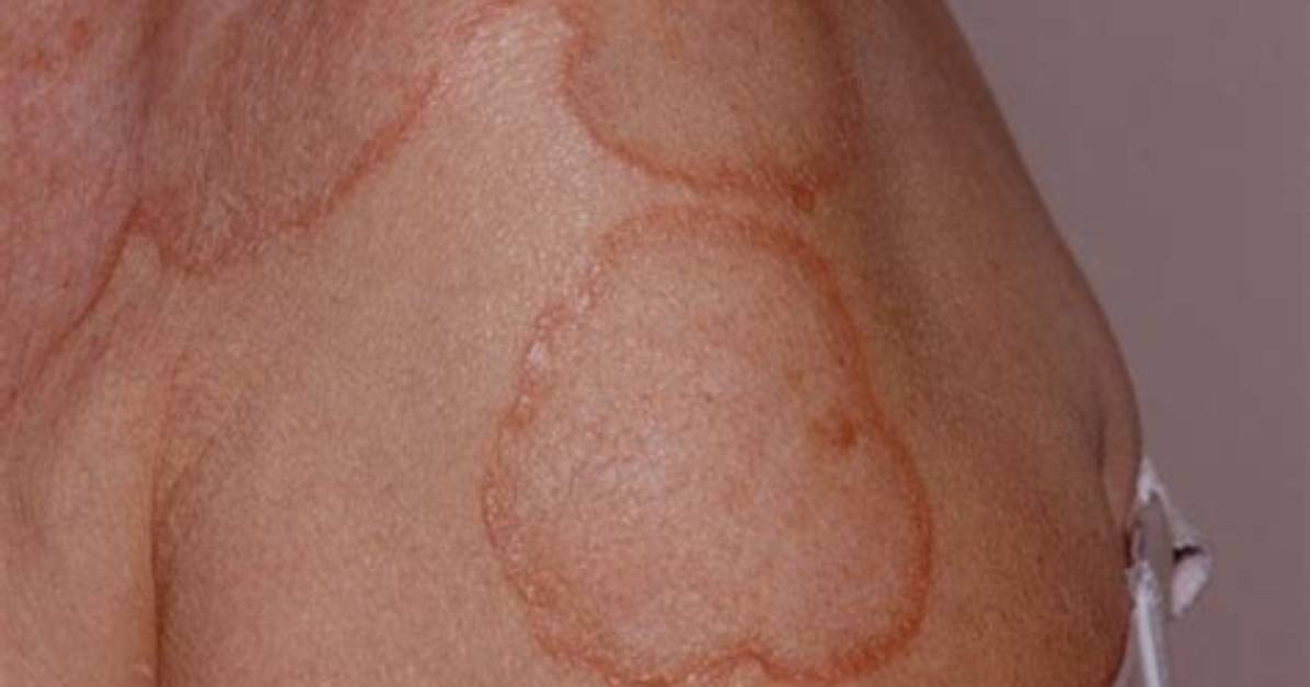 What Is Annular Rash