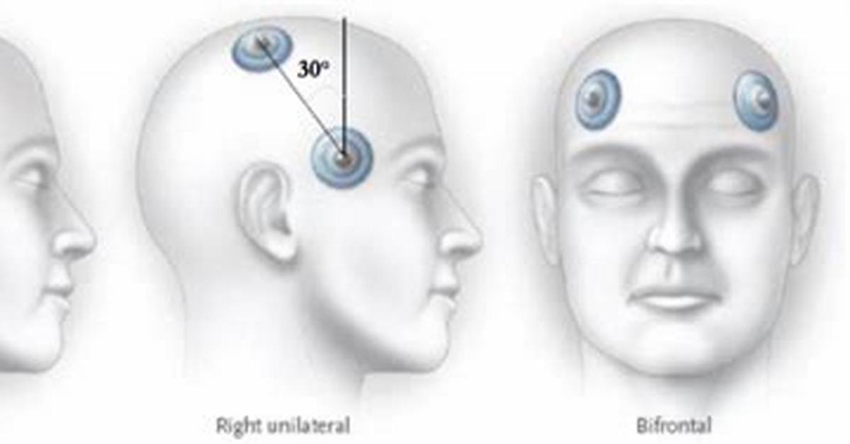 What Is Bifrontal Ect?