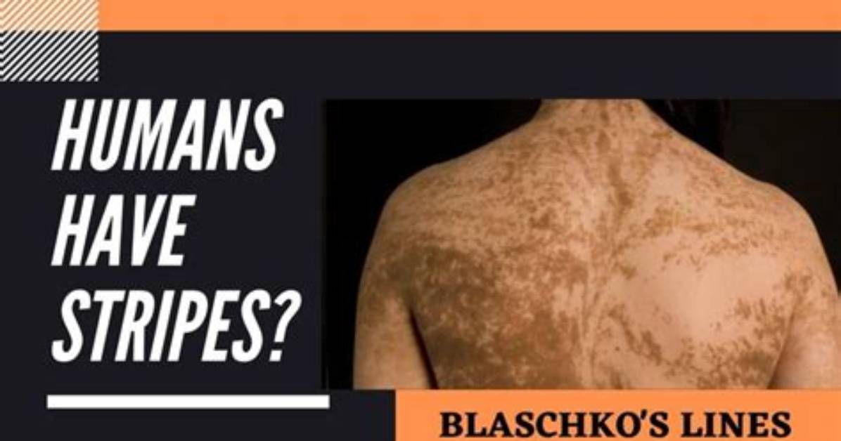 What Is Blaschko's Lines?