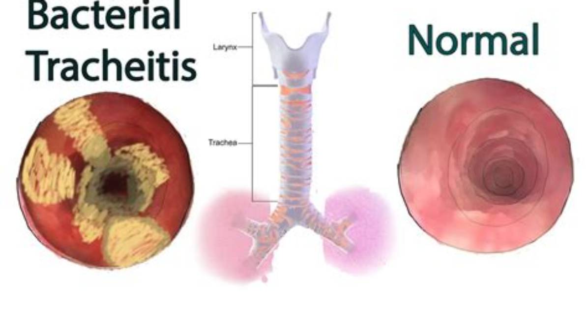 What Is Bronchial Tracheitis