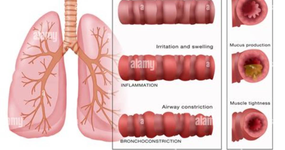 What Is Bronchiolar Constriction?