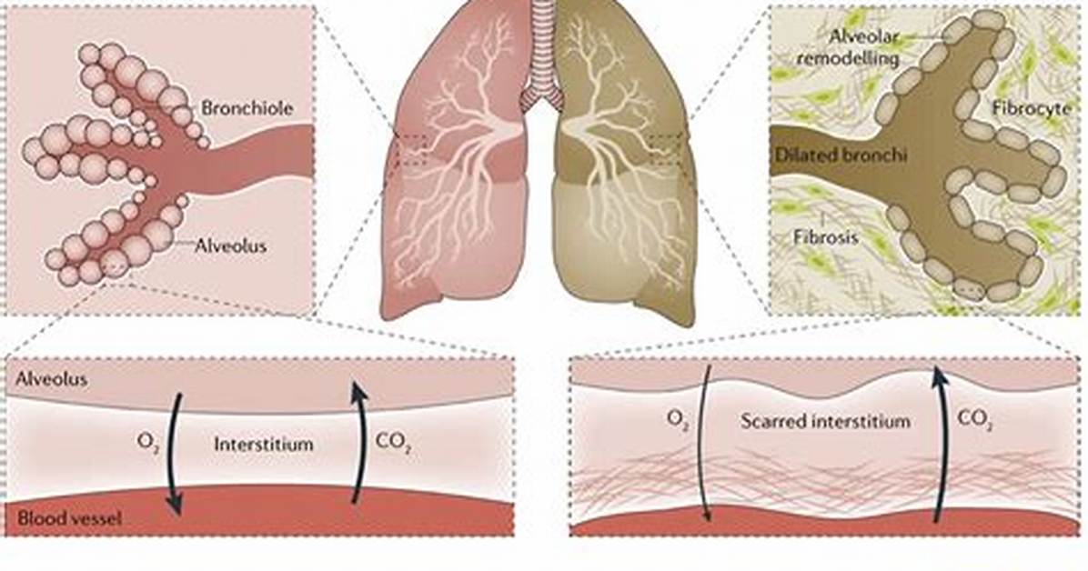 What Is Bronchitic Changes?