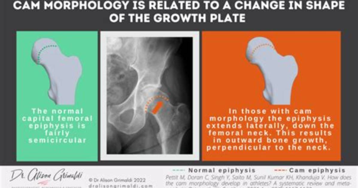 What Is Cam Type Morphology