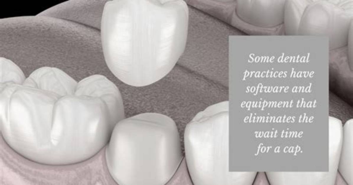 What Is Capping a Tooth?