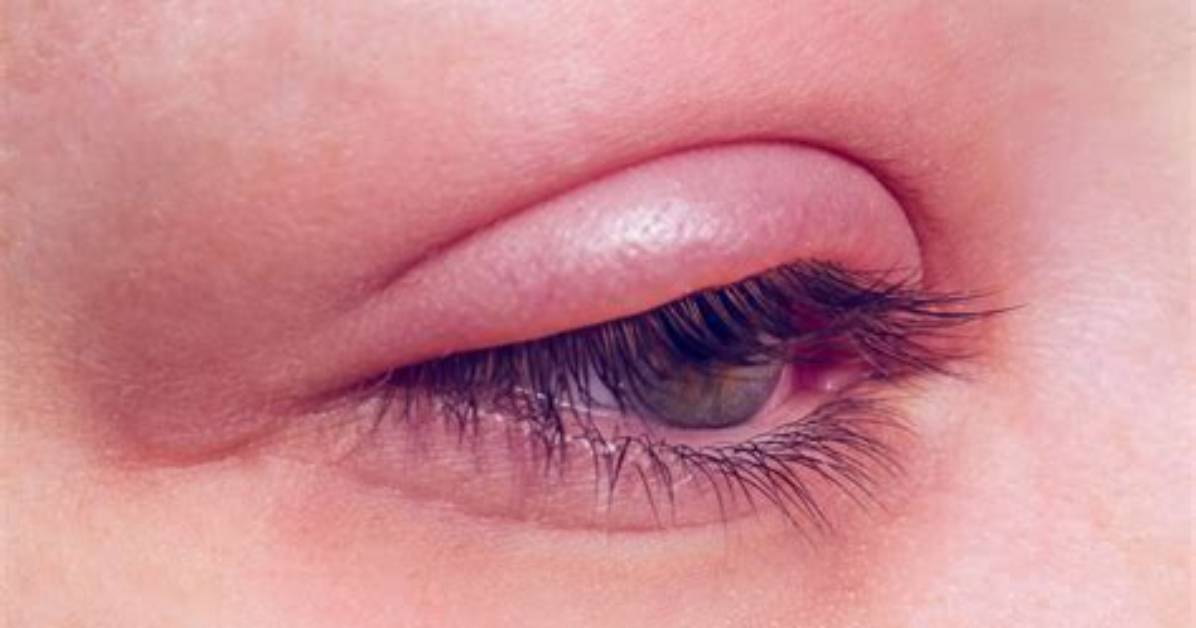 What Is Causing My Swollen Eyelids?