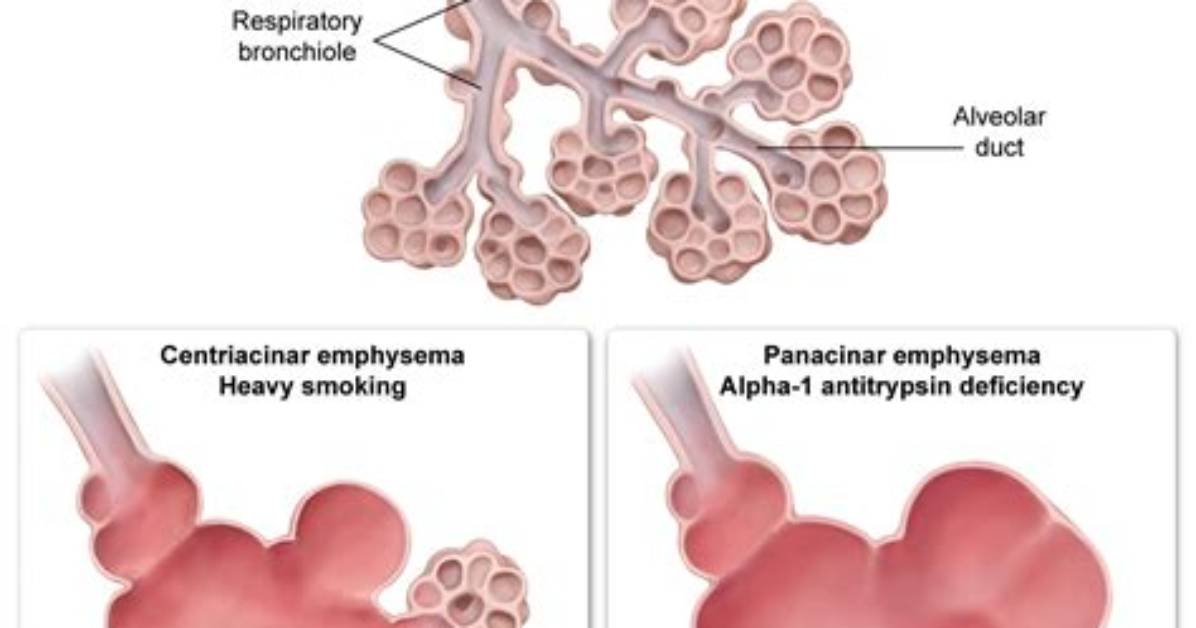What Is Centriacinar Emphysema