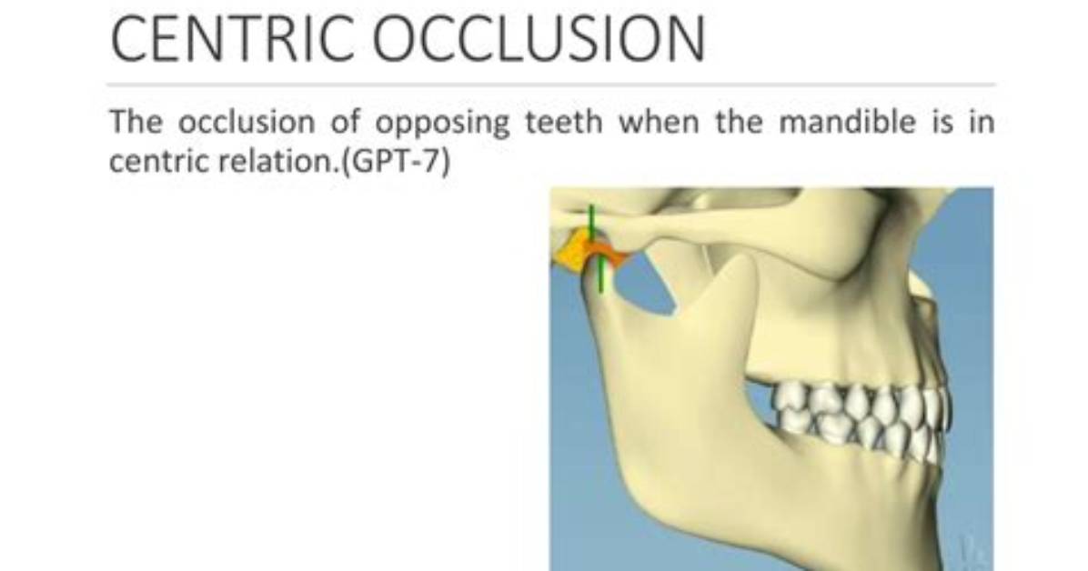 What Is Centric Occlusion?