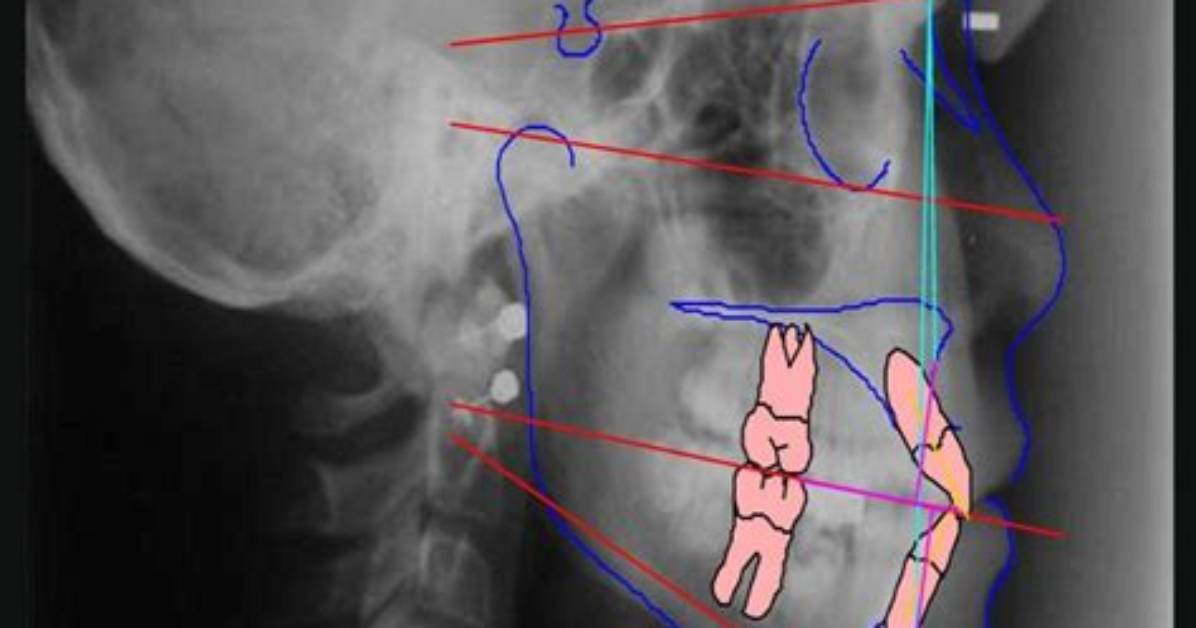 What Is Cephalometric Analysis?