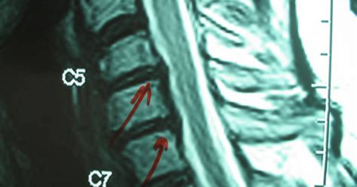 What Is Cervical Pid