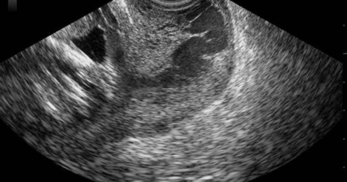 What Is Cervical Varix?