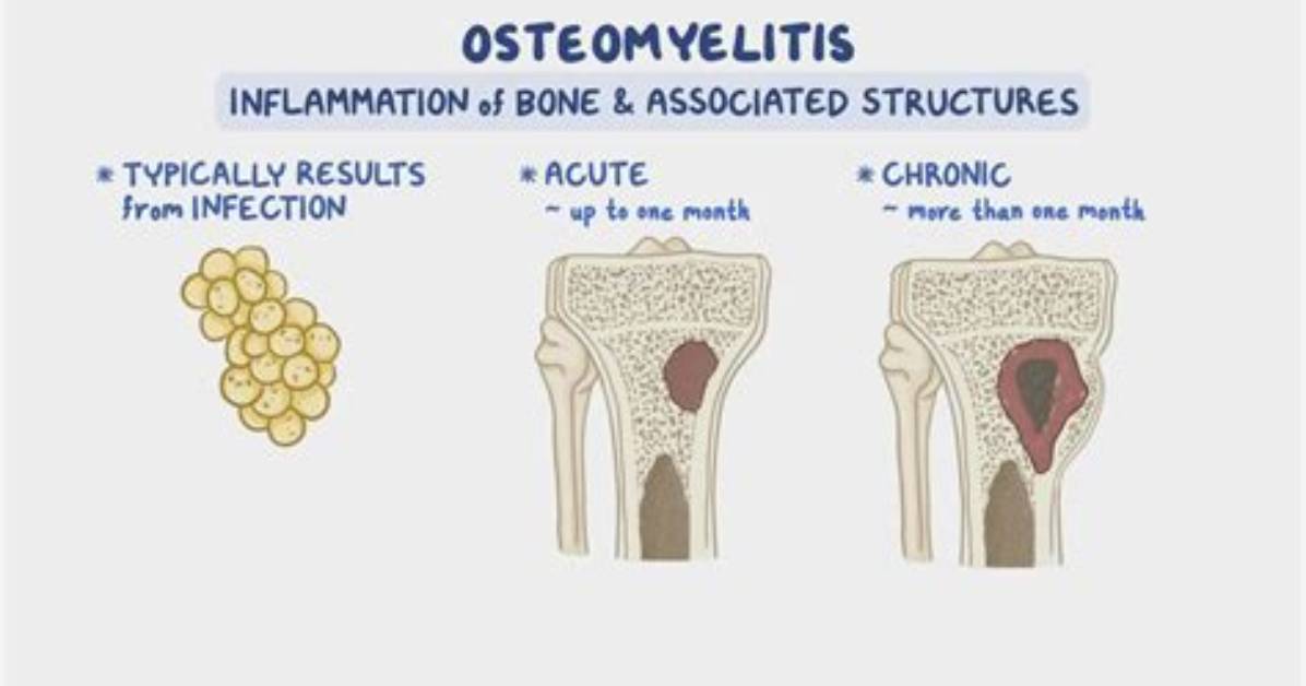 What Is Chronic Hematogenous Osteomyelitis?
