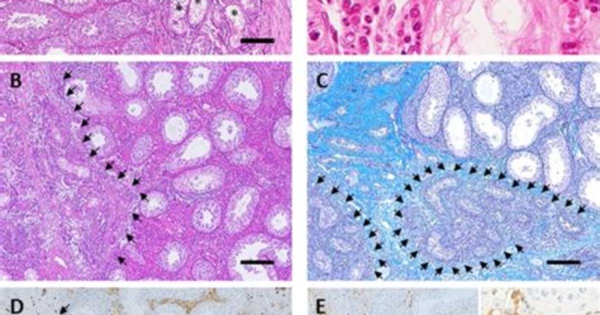 What Is Chronic Orchitis?