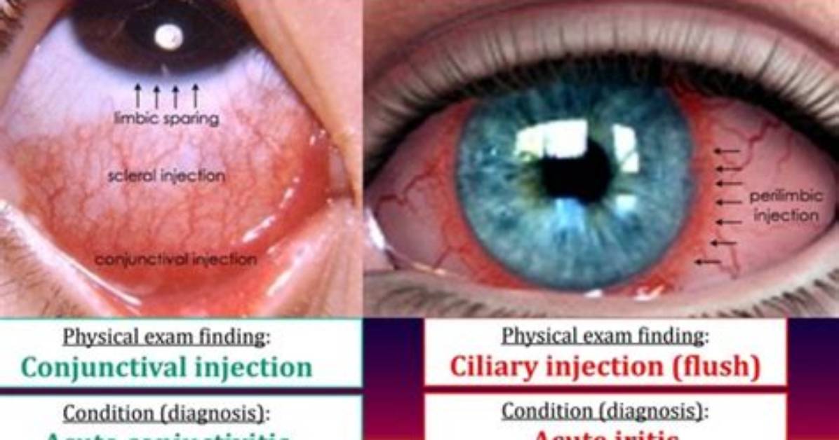 What Is Ciliary Injection