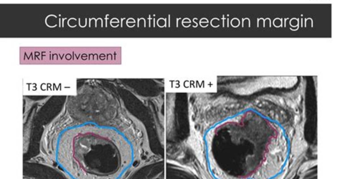 What Is Circumferential Resection Margin?