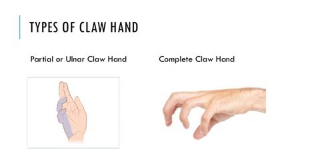 What Is Claw Hand
