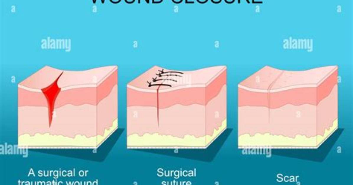 What Is Closed Wound