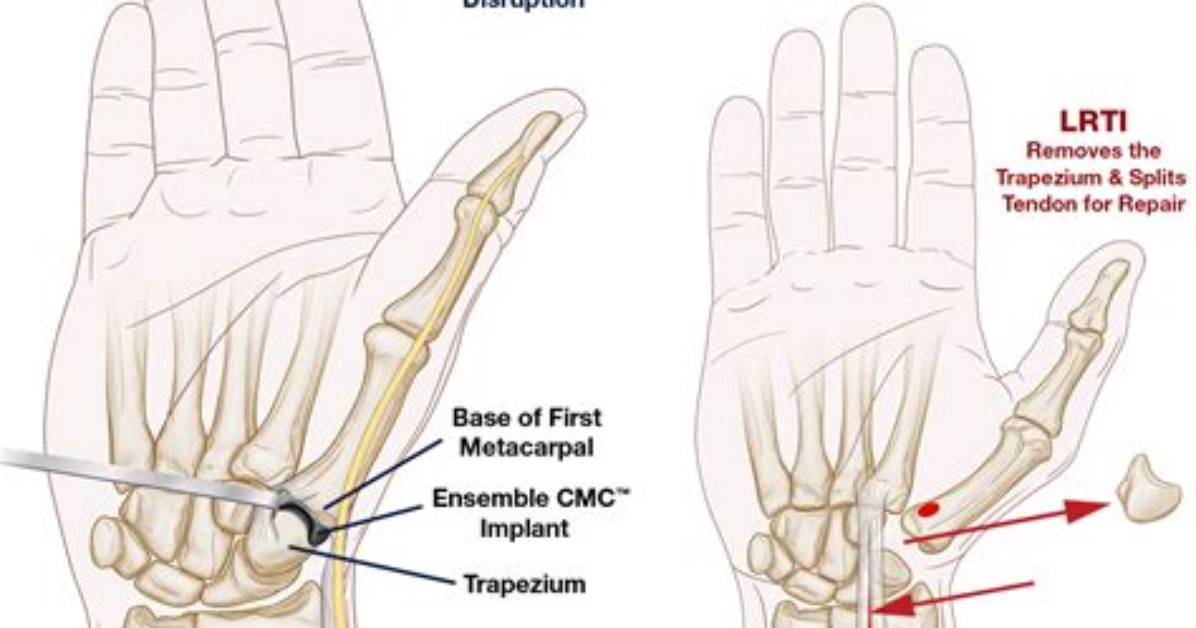 What Is Cmc Surgery