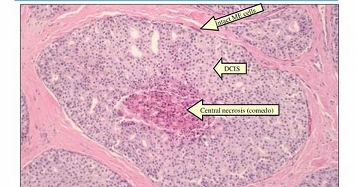 What Is Comedo Type Dcis