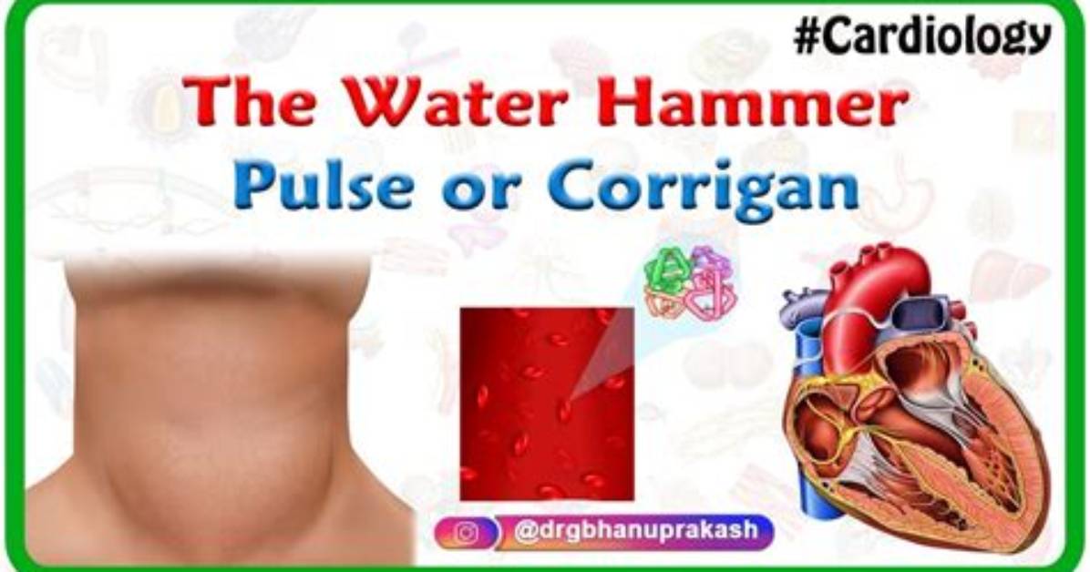 What Is Corrigan Pulse