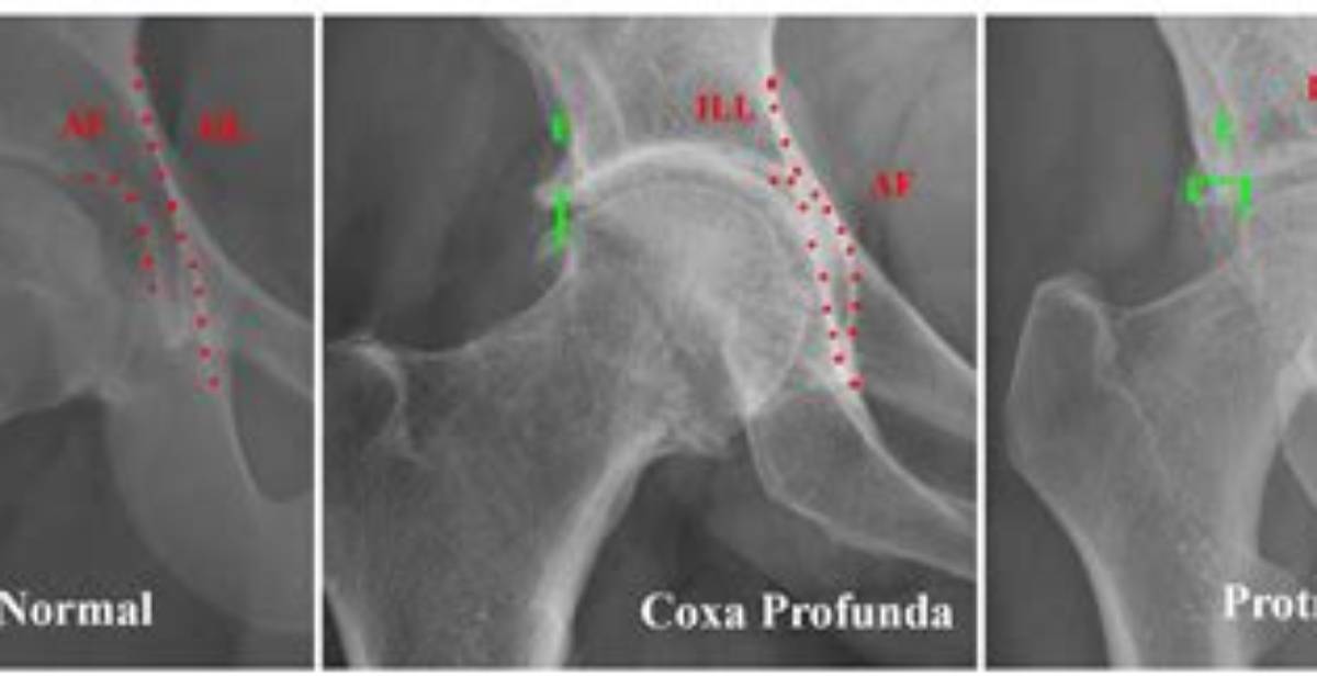What Is Coxa Profunda
