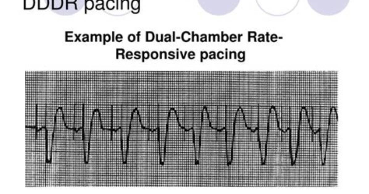 What Is Dddr Pacing