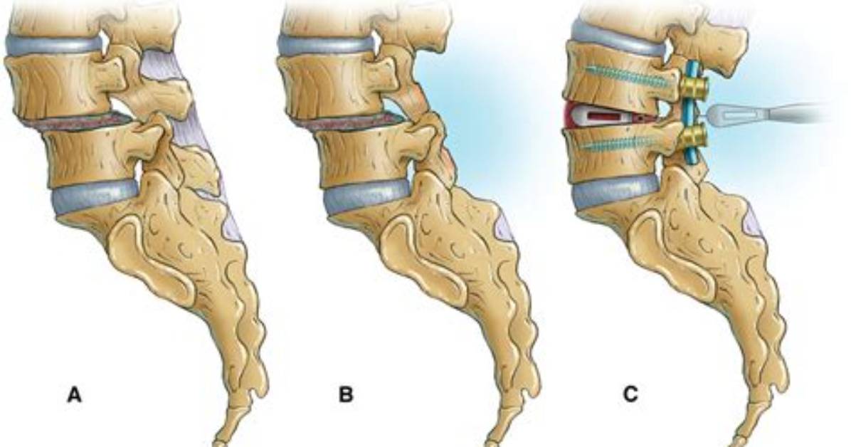 What Is Decompressive Lumbar Laminectomy?