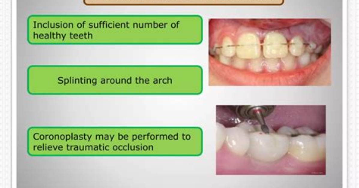What Is Dental Splinting? | Contextresponse. Com