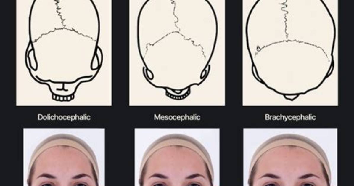 What Is Dolichocephalic Head?