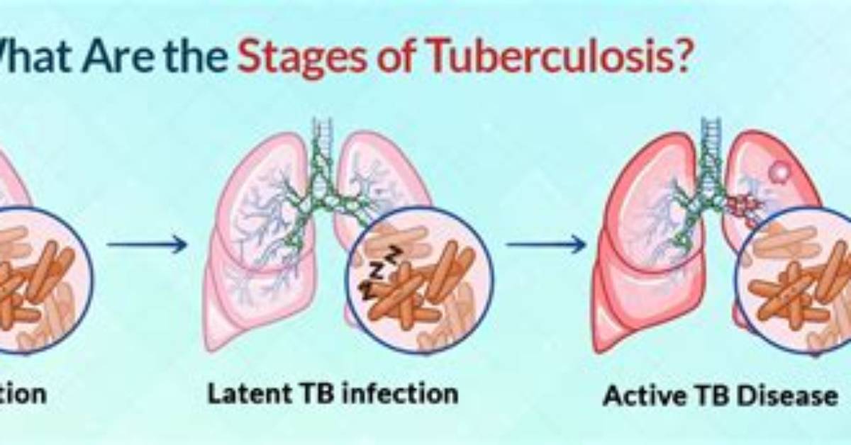 What Is Dormant Tb