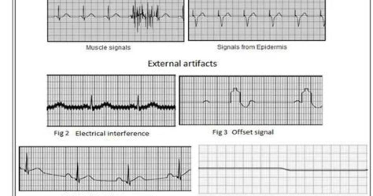 What Is Ecg Artifact