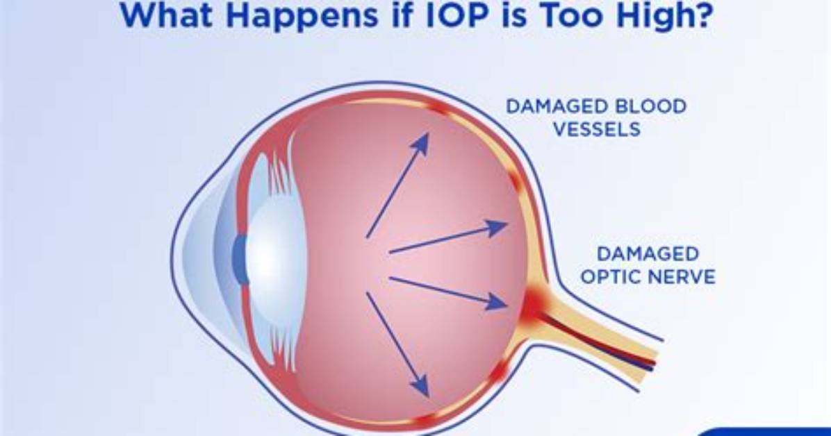What Is Elevated Iop