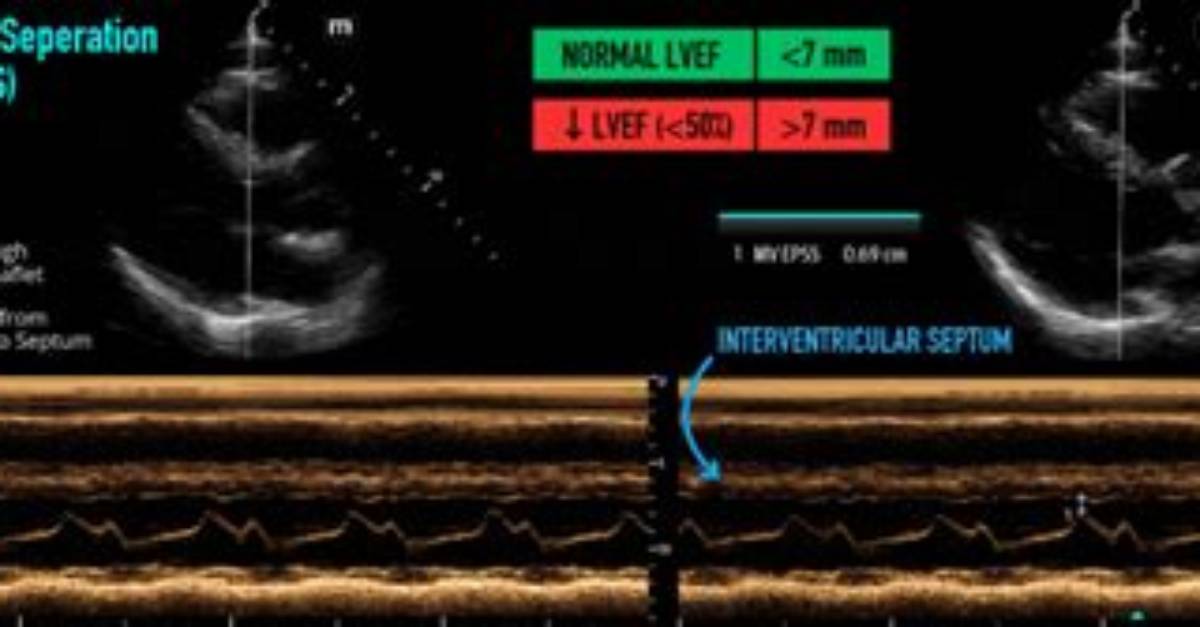 What Is Epss Echo