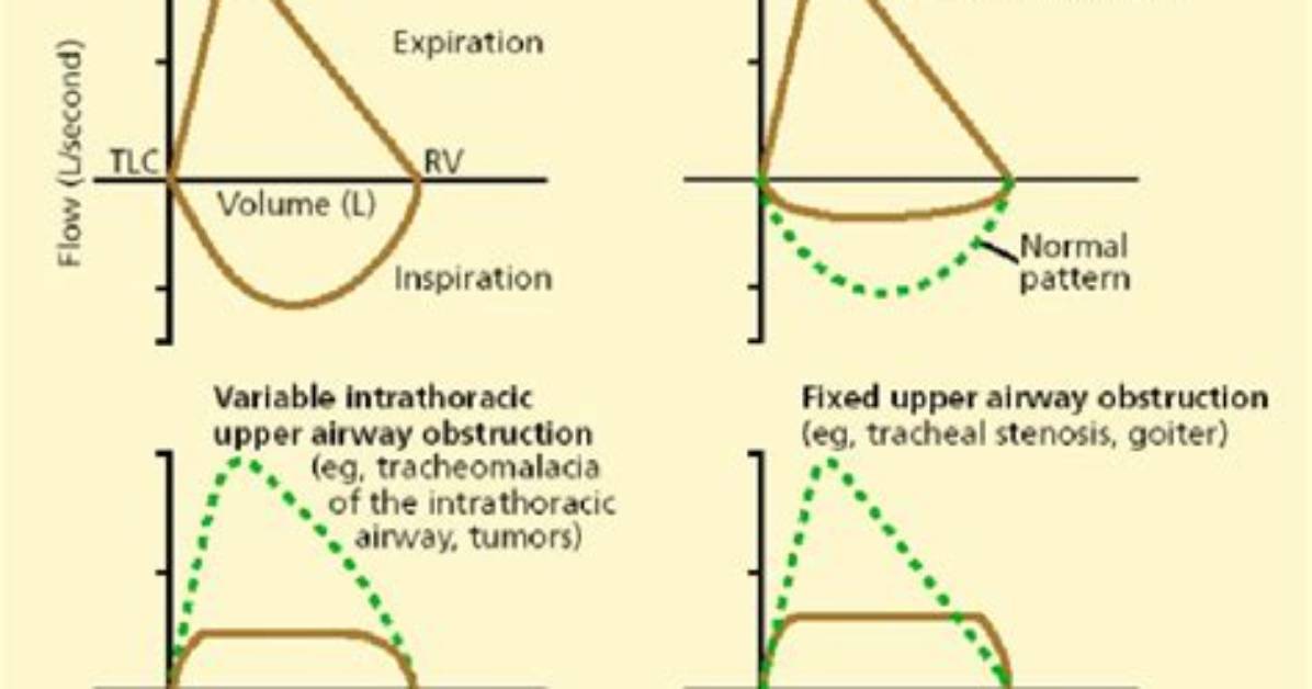 What Is Extrathoracic Obstruction