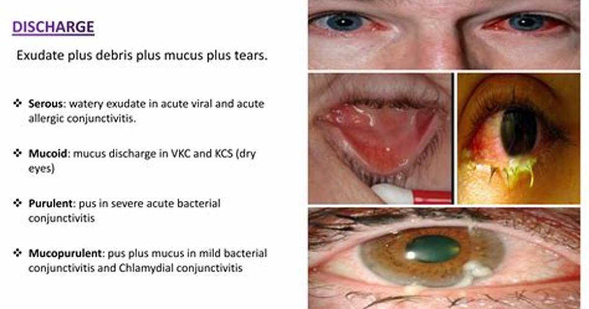 What Is Eye Exudate