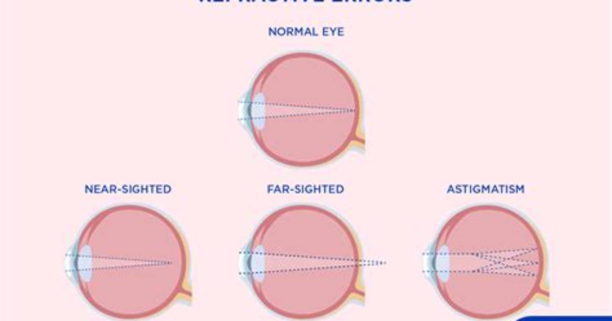 What Is Eye Refraction