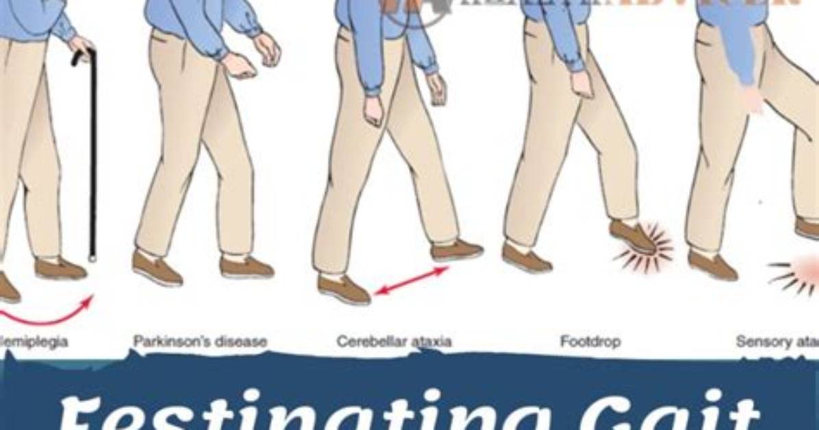 What Is Festinating Gait?
