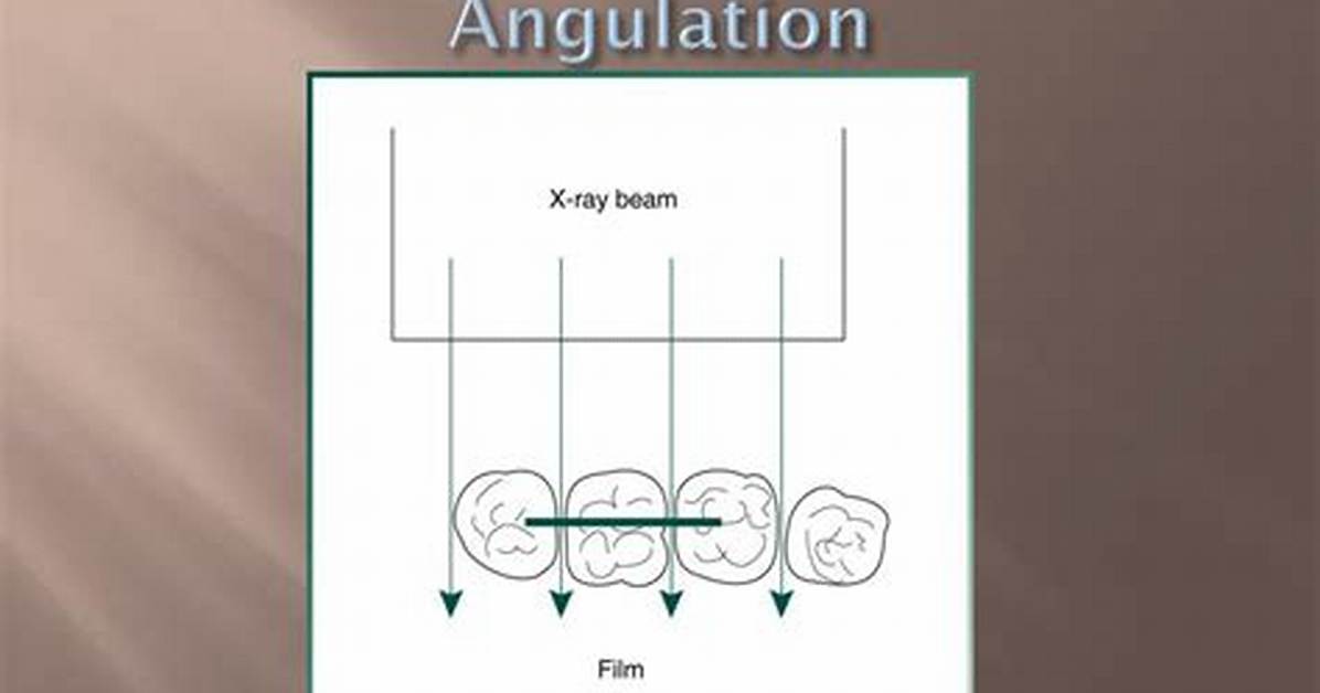 What Is Horizontal Angulation