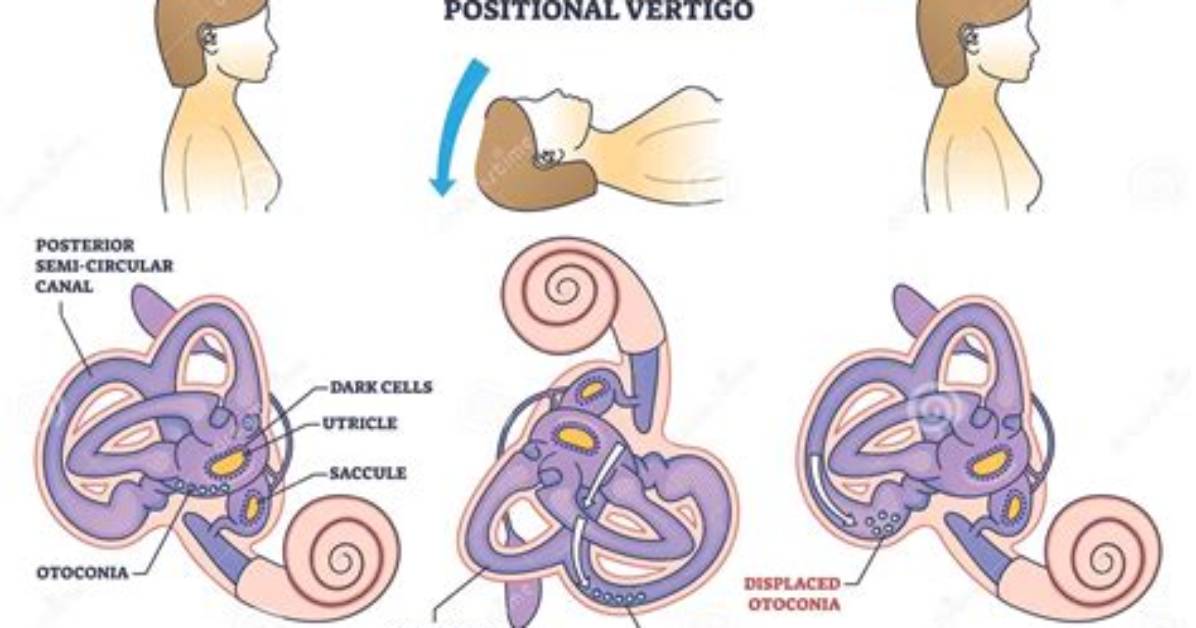 What Is Horizontal Bppv