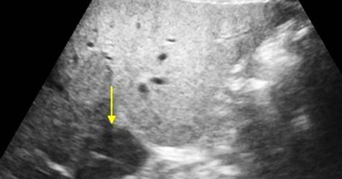What Is Hypoechoic Liver