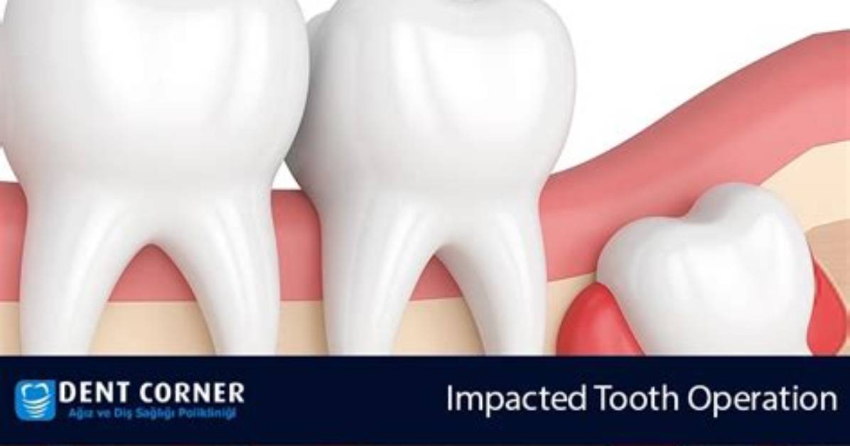 What Is Imbedded Tooth?